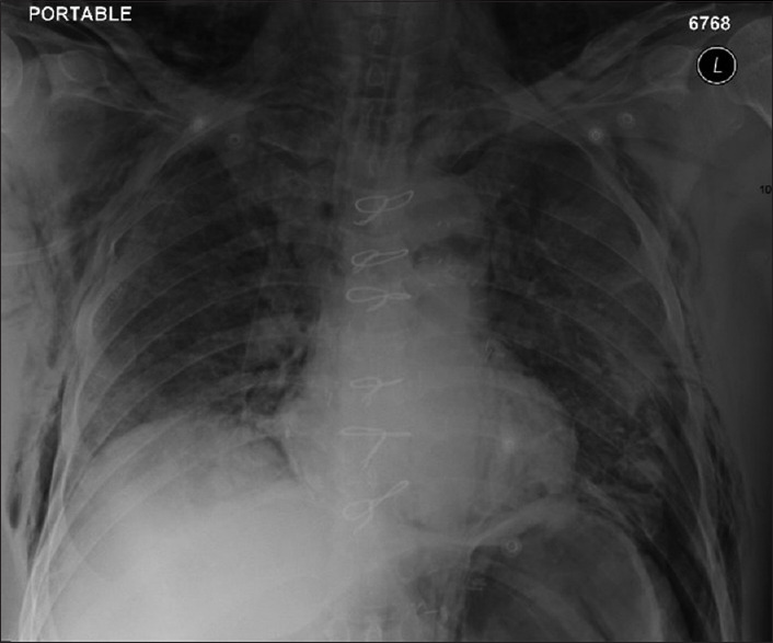 Surgical and mediastinal emphysema in critically ill COVID-19 patients: A multicentric experience.