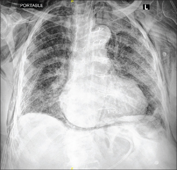 Surgical and mediastinal emphysema in critically ill COVID-19 patients: A multicentric experience.