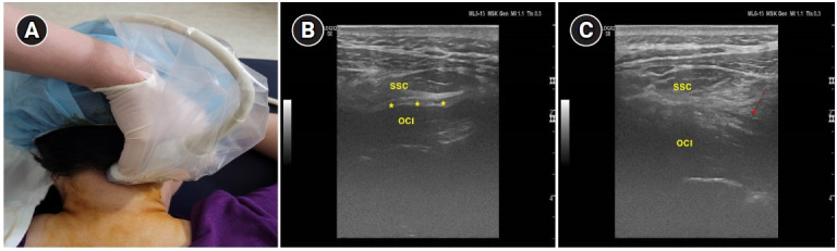 Greater occipital nerve blockade using ultrasound guidance for the headache of spontaneous intracranial hypotension - A case report.