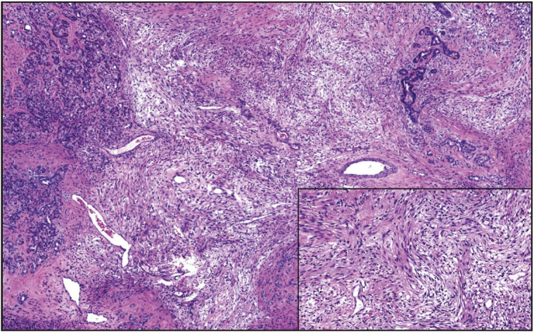 Mesenchymal Tumors Involving the Pancreas: A Clinicopathologic Analysis and Review of the Literature.