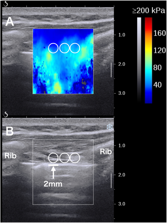 Effect of chest mobilization on intercostal muscle stiffness