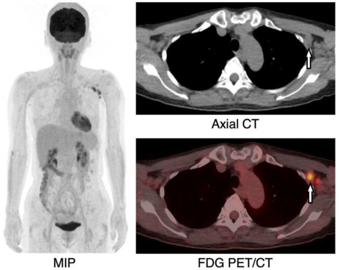 Unilateral axillary lymph node fluorodeoxyglucose uptakes after coronavirus disease 2019 vaccination.