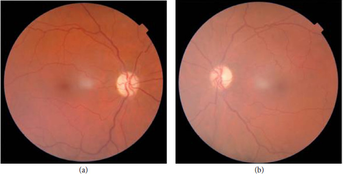 Clinical Overview of Leber Hereditary Optic Neuropathy.