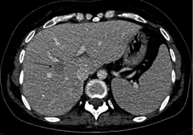 Hepatic granuloma mimicking recurrent lymphoma on <sup>18</sup>F-FDG PET/CT in a patient with primary mediastinal diffuse large B-cell lymphoma.