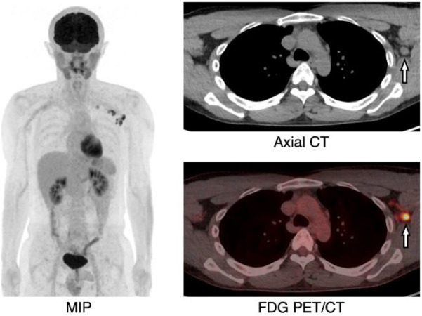 Unilateral axillary lymph node fluorodeoxyglucose uptakes after coronavirus disease 2019 vaccination.