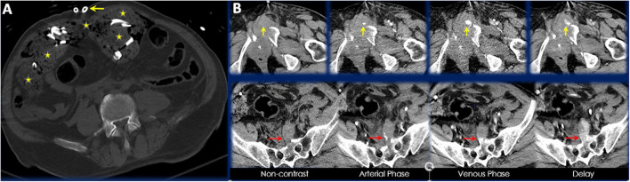 Single Center Retrospective Review of Post-laparotomy CT Abdomen and Pelvis Findings and Trends.