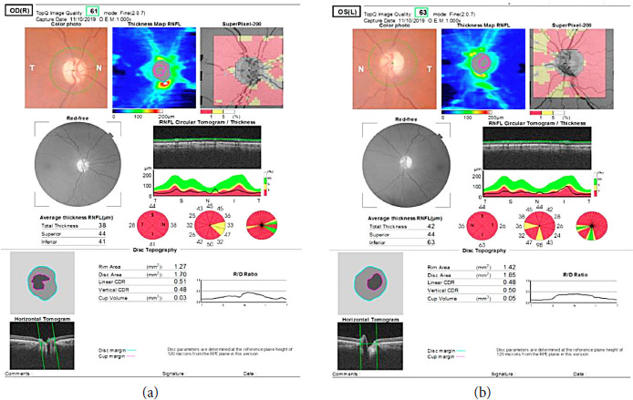 Clinical Overview of Leber Hereditary Optic Neuropathy.