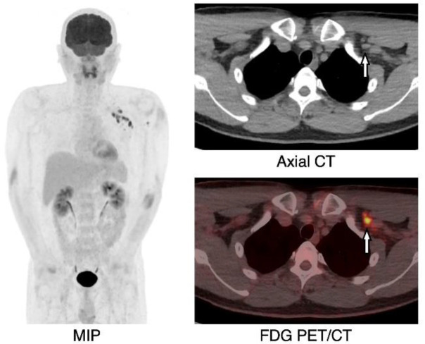 Unilateral axillary lymph node fluorodeoxyglucose uptakes after coronavirus disease 2019 vaccination.