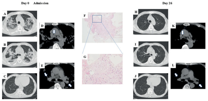 Pulmonary sarcoidosis with lung injury induced by shin'iseihaito.