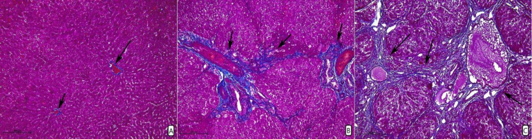 FN14 mRNA Expression Correlates with an Increased Number of Veins during Angiogenesis in the Process of Liver Fibrosis.