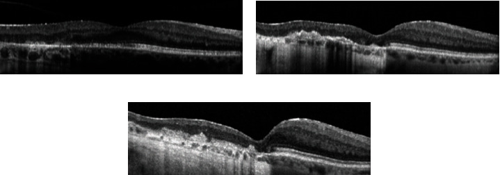 Sustained Control of Serpiginous Choroiditis with the Fluocinolone Acetonide 0.18 mg Intravitreal Implant.