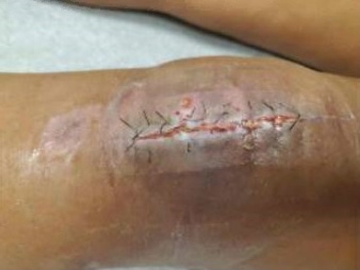 Lower Extremity Salvage in a Diabetic Patient With Cutaneous Mucormycosis and COVID-19 After Open Patella Fracture.