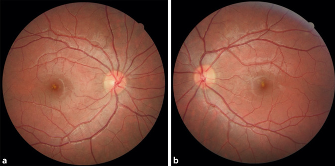 [Sudden bilateral loss of vision with scotomas].