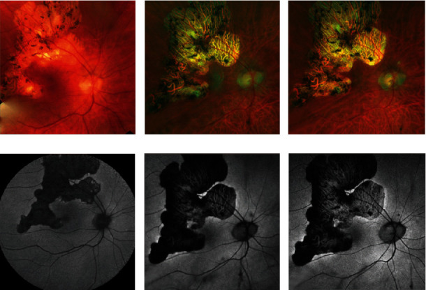 Sustained Control of Serpiginous Choroiditis with the Fluocinolone Acetonide 0.18 mg Intravitreal Implant.