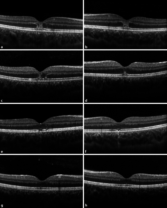 [Sudden bilateral loss of vision with scotomas].