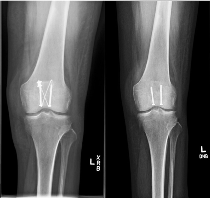Lower Extremity Salvage in a Diabetic Patient With Cutaneous Mucormycosis and COVID-19 After Open Patella Fracture.