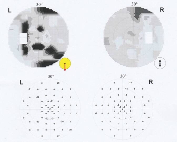 [Sudden bilateral loss of vision with scotomas].