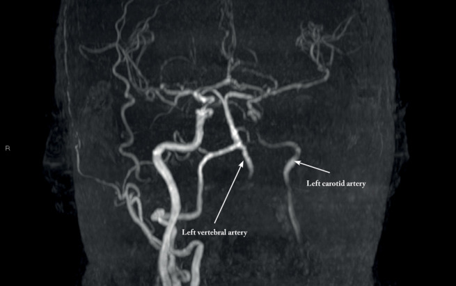 An unusual case of takayasu arteritis presenting as acute myocardial infarction and ischaemic stroke.