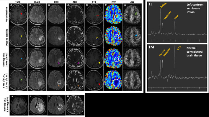 Conventional and Advanced Imaging Techniques in Post-treatment Glioma Imaging.