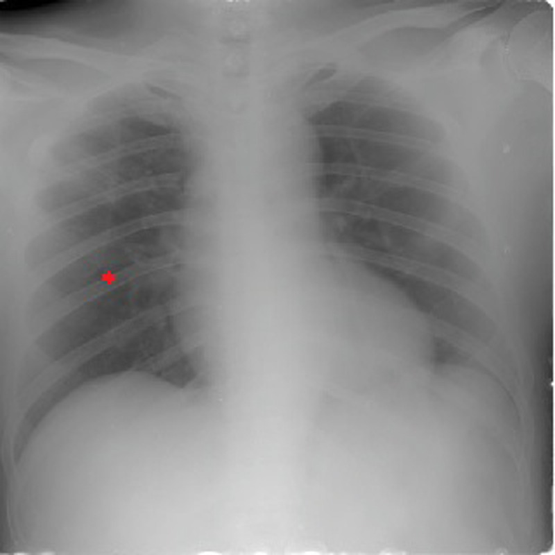 Complicated Case of Multidrug-Resistant Tuberculosis with Multiple Comorbidities, Successfully Treated After Several Treatment Modifications.