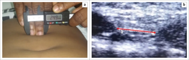 Diastasis recti in the Beninese population: Cross-sectional study from normal values to diagnosis.