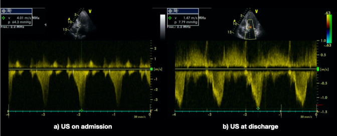 The Takotsubo Syndrome: Clinical Diagnosis Using POCUS.