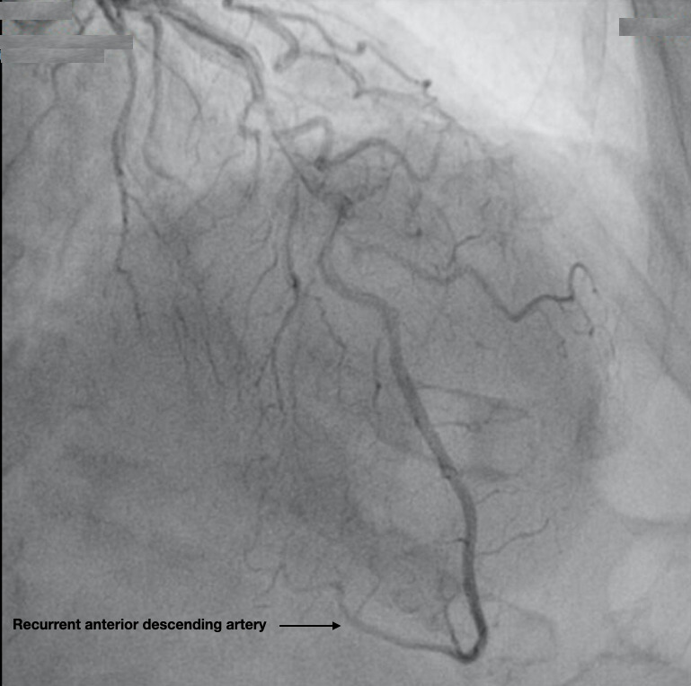 The Takotsubo Syndrome: Clinical Diagnosis Using POCUS.