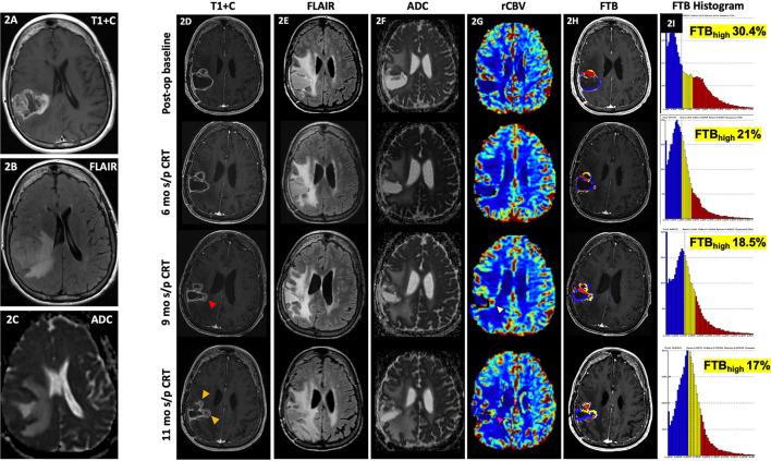 Conventional and Advanced Imaging Techniques in Post-treatment Glioma Imaging.