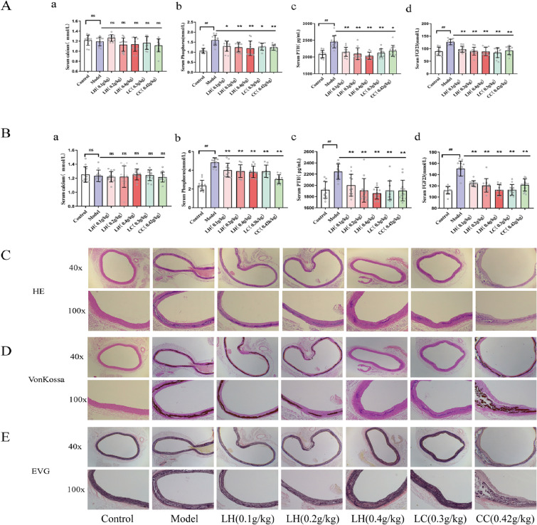 Metabolomics of clinical samples reveal the treatment mechanism of lanthanum hydroxide on vascular calcification in chronic kidney disease.