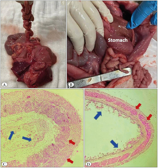 Apple Peel Deformity and Malrotation of Gut: Autopsy Findings of a Rare Cause of Mortality in Utero.