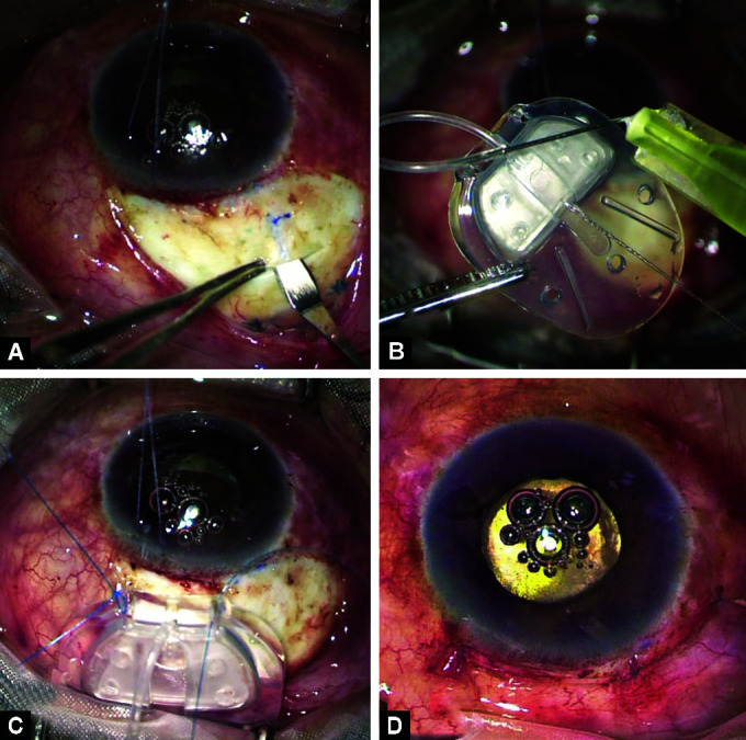 A Long-term Clinical Study to Evaluate AGV with Concurrent Intravitreal Ranibizumab vs Primary AGV Implantation in Cases of Refractory Neovascular Glaucoma.