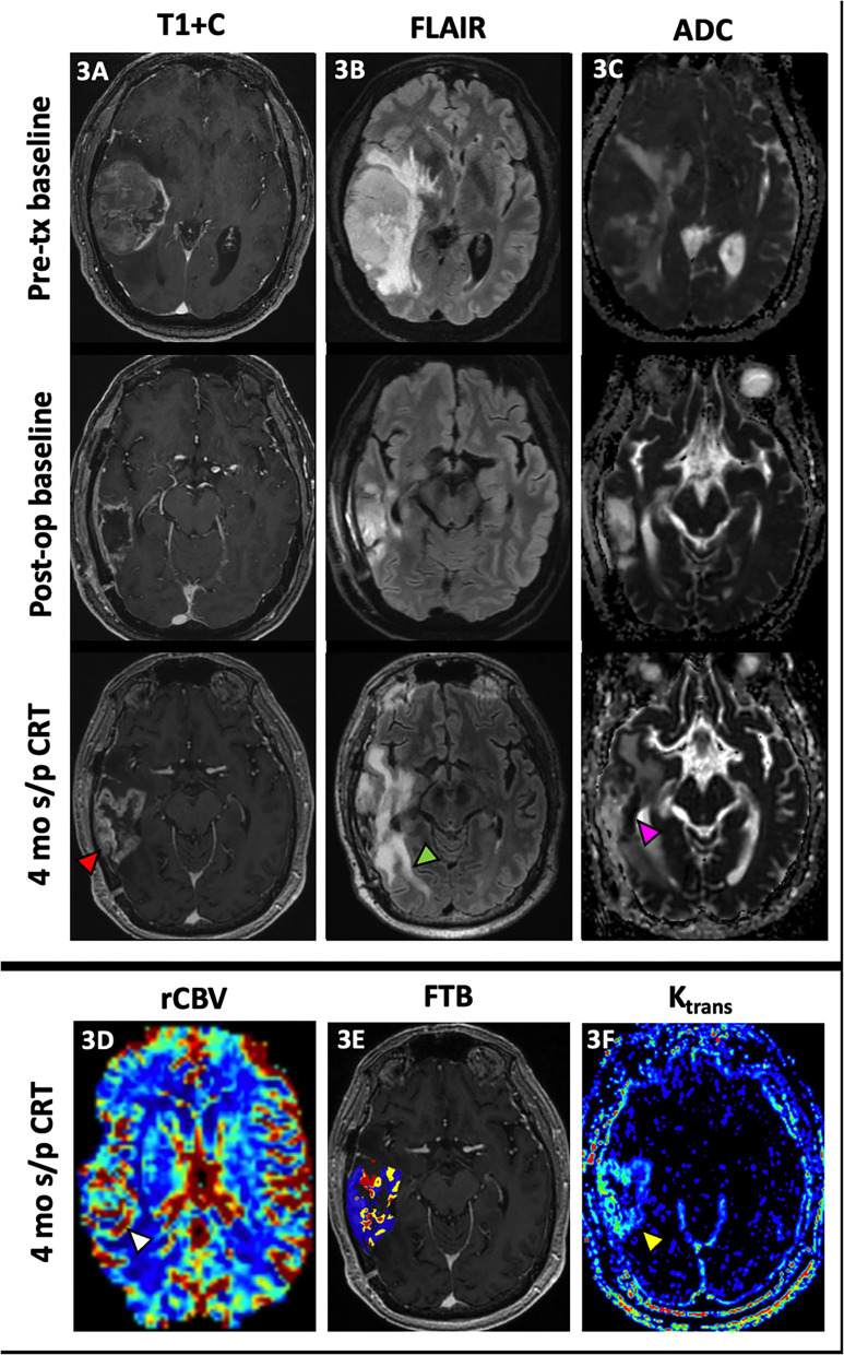 Conventional and Advanced Imaging Techniques in Post-treatment Glioma Imaging.