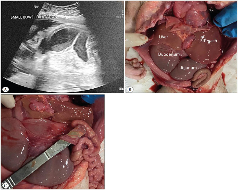 Apple Peel Deformity and Malrotation of Gut: Autopsy Findings of a Rare Cause of Mortality in Utero.