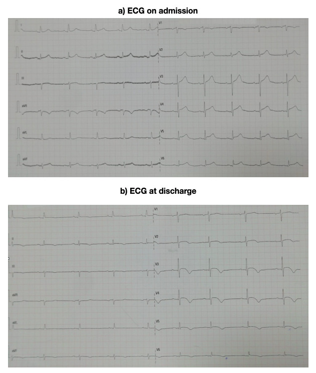 The Takotsubo Syndrome: Clinical Diagnosis Using POCUS.