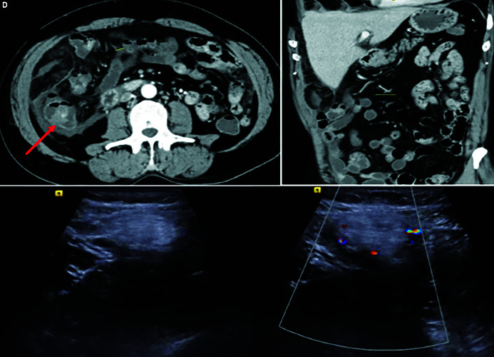 Imaging of Mischievous Intra-abdominal Fat Presenting with Abdominal Pain: A Pictorial Review.