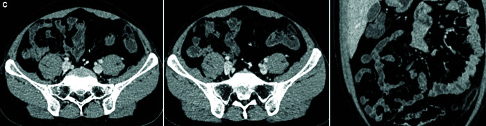 Imaging of Mischievous Intra-abdominal Fat Presenting with Abdominal Pain: A Pictorial Review.