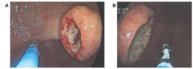 Primary Gastric Malignant Melanoma in a 68-Year-Old Woman: A Case Report and Review of the Literature.