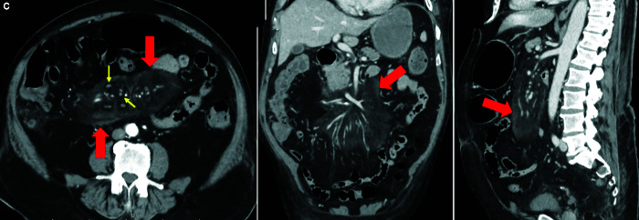 Imaging of Mischievous Intra-abdominal Fat Presenting with Abdominal Pain: A Pictorial Review.