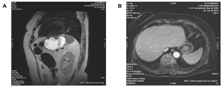 Primary Gastric Malignant Melanoma in a 68-Year-Old Woman: A Case Report and Review of the Literature.