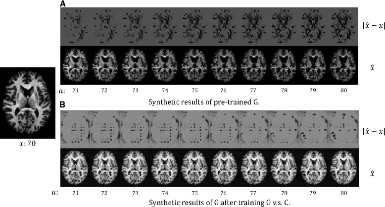 Adversarial counterfactual augmentation: application in Alzheimer's disease classification.