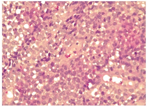 Primary Gastric Malignant Melanoma in a 68-Year-Old Woman: A Case Report and Review of the Literature.