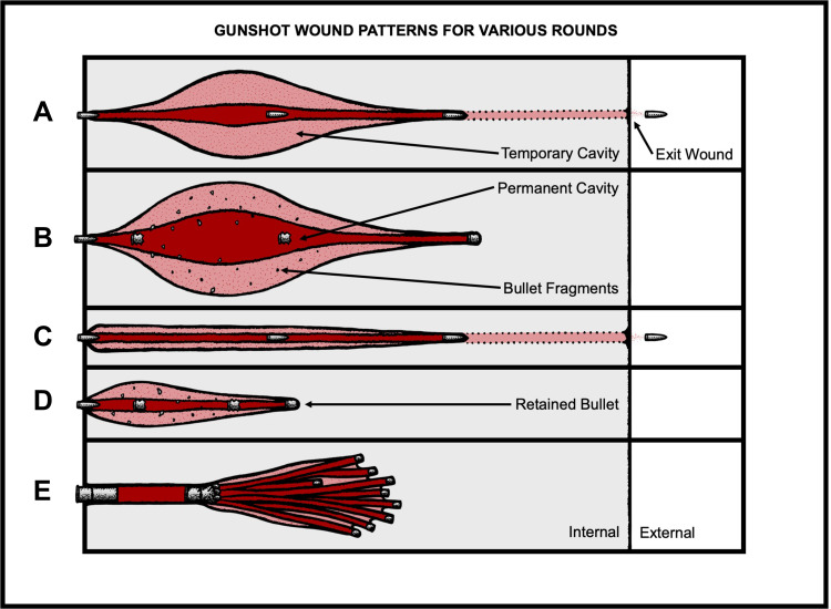 Gunshot Wounds: Ballistics, Pathology, and Treatment Recommendations, with a Focus on Retained Bullets.