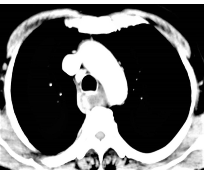 Esophageal Intramural Haematoma related Dysphagia: A rare complication after thrombolysis.