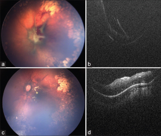 Multimodal Imaging, Tele-Education, and Telemedicine in Retinopathy of Prematurity.