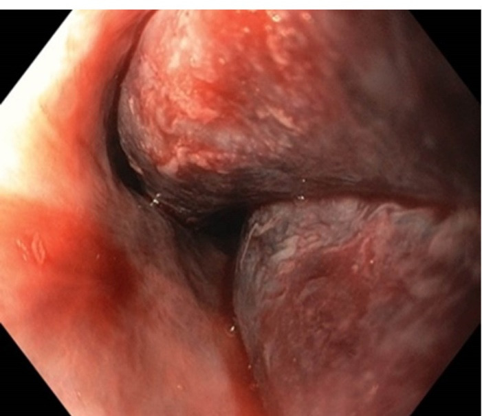 Esophageal Intramural Haematoma related Dysphagia: A rare complication after thrombolysis.