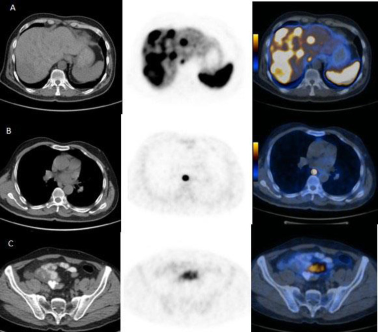 <sup>68</sup>Ga-DOTATATE Radioisotope scan to detect neuroendocrine tumors; A Cross-Sectional Study.