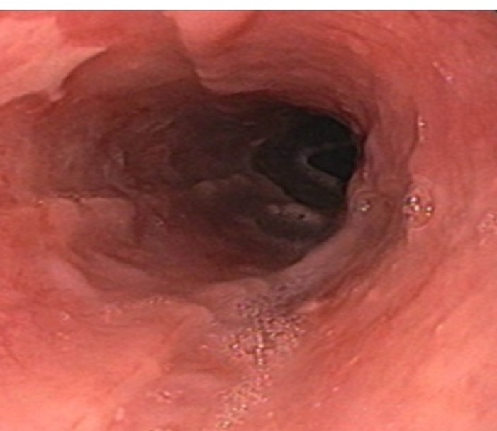 Esophageal Intramural Haematoma related Dysphagia: A rare complication after thrombolysis.