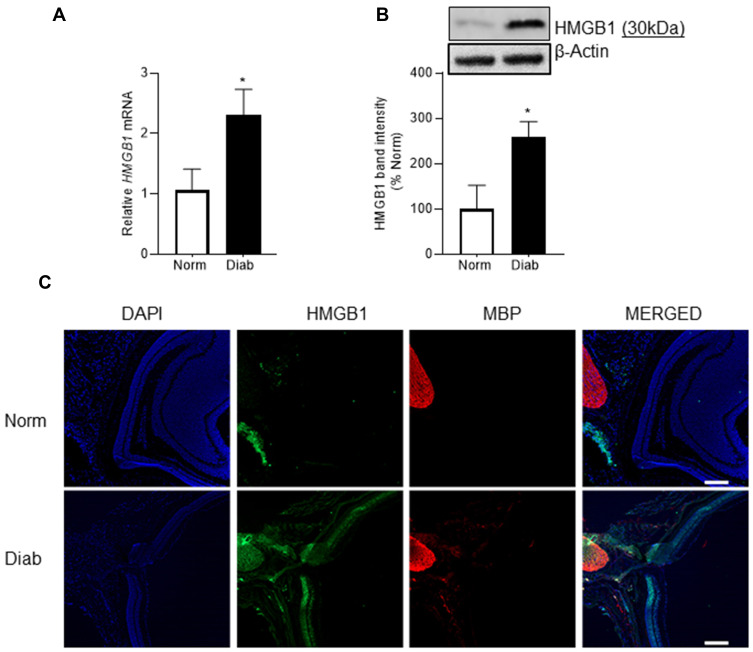 Involvement of High Mobility Group Box 1 Protein in Optic Nerve Damage in Diabetes.