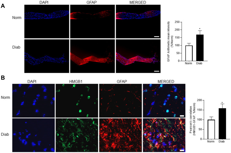 Involvement of High Mobility Group Box 1 Protein in Optic Nerve Damage in Diabetes.