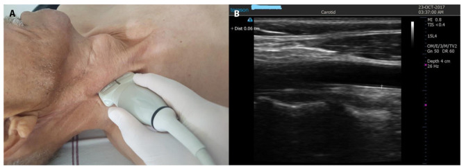 Atherogenic Indices Can Predict Atherosclerosis in Patients with Sarcoidosis.